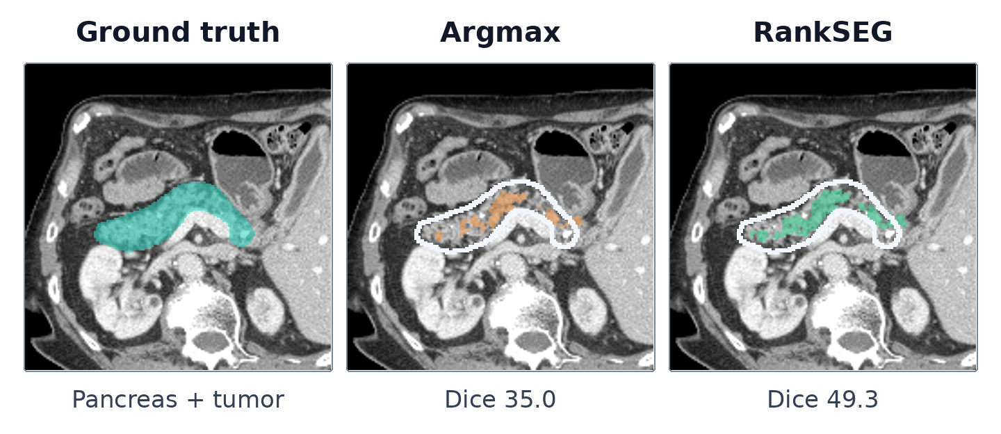Pancreas CT slice: ground truth, argmax (Dice 35.0), and RankSEG (Dice 49.3). White outlines mark ground truth.