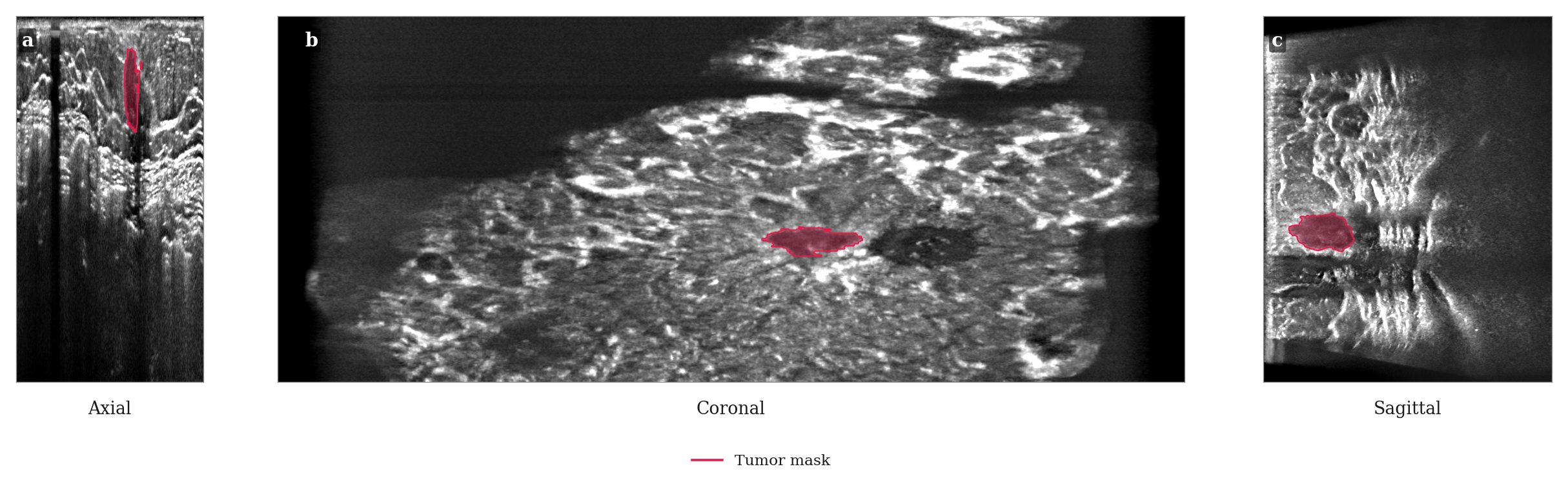 Axial, coronal and sagittal views of the same tumor produced by ViewTransformer