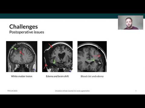 MICCAI 2020 - Fernando Pérez-García - Simulation of resection cavity for self-supervised learning