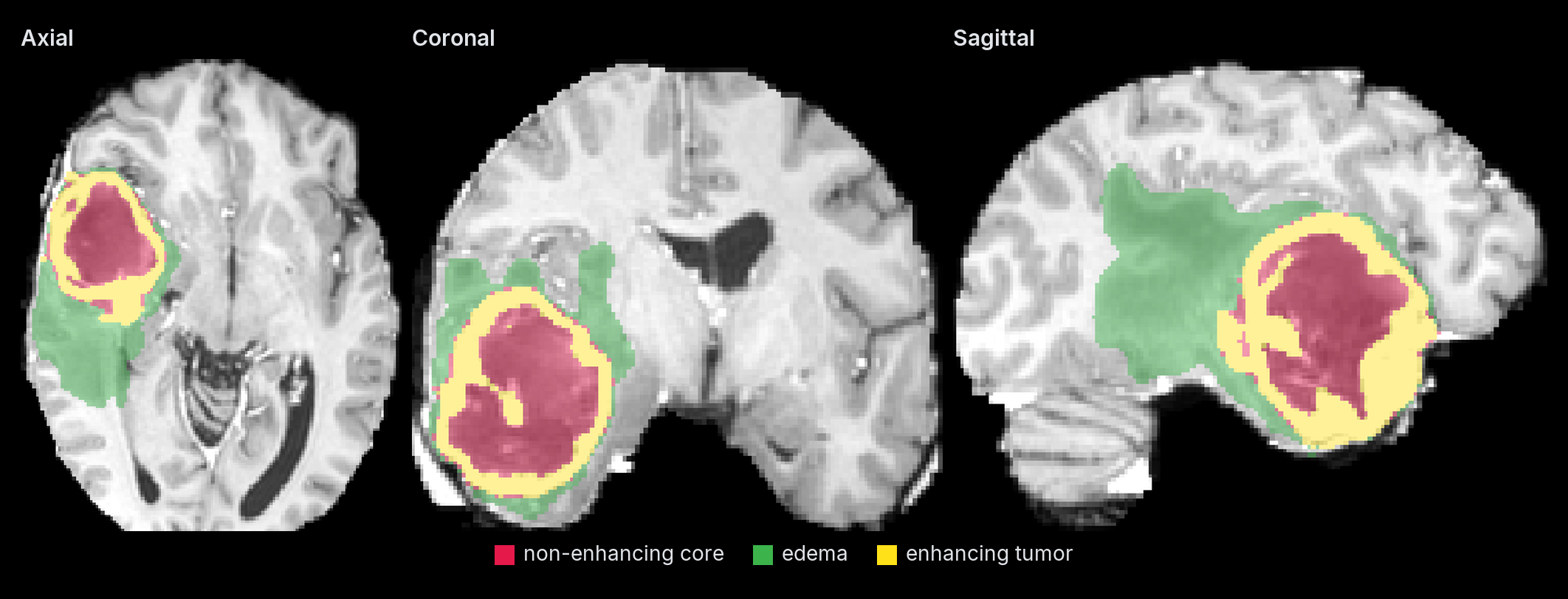SegResNet brain tumor segmentation in axial, coronal and sagittal views