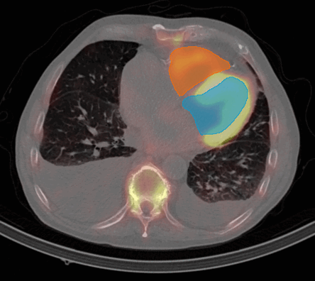 IVS Volume Quantification Process