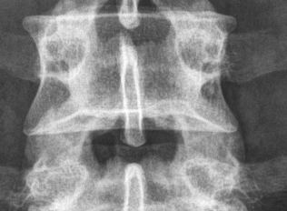 Vertebrae