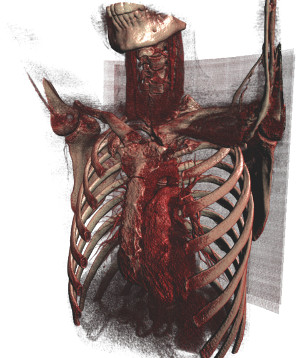 Alpha blending ray casting rendering of a thorax CT image.