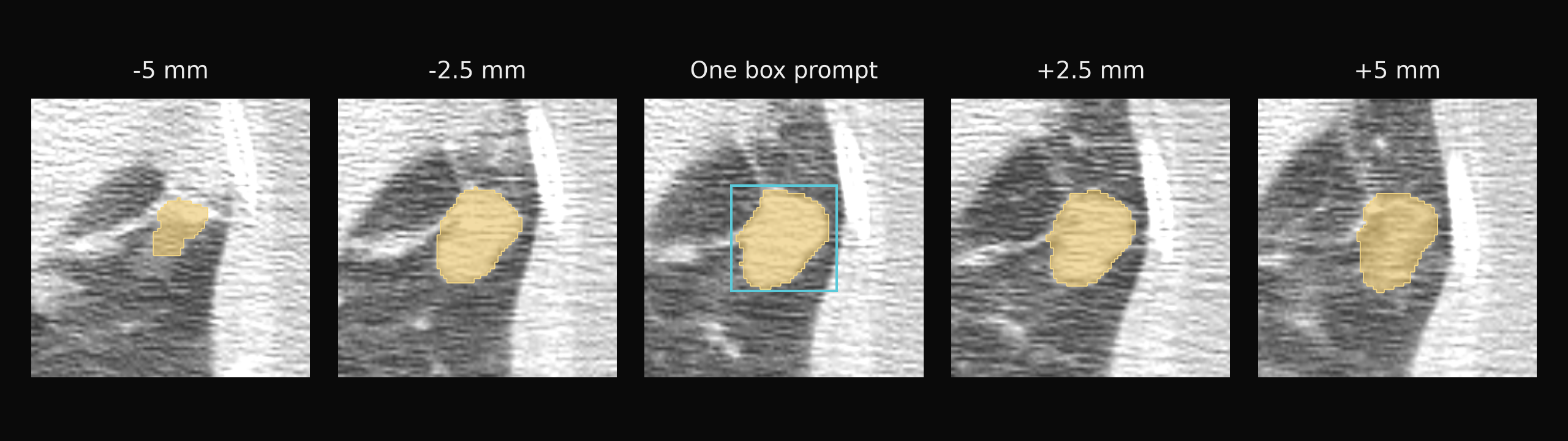 One box prompt → nodule masks propagated across neighboring CT slices.