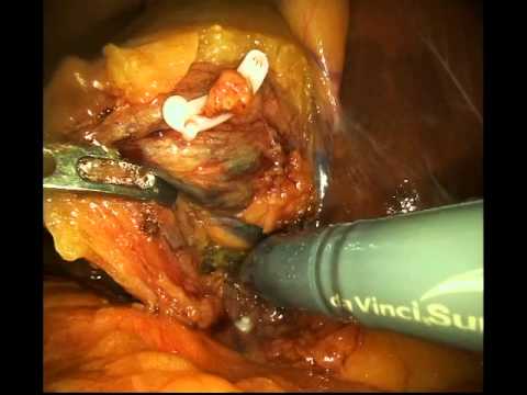 Exemplary surgery video