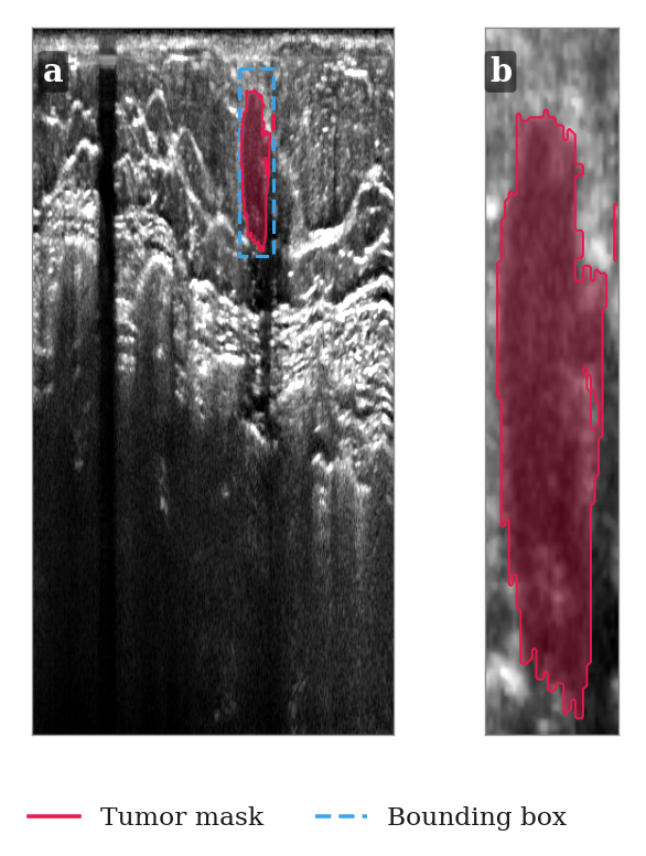 Axial slice with tumor mask and bounding box, next to the TDSCTumors crop