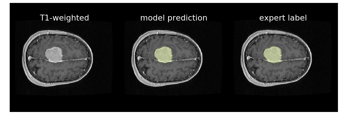 Meningioma extraction model prediction