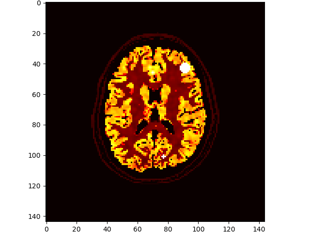 https://raw.githubusercontent.com/casperdcl/brainweb/master/lesions.png