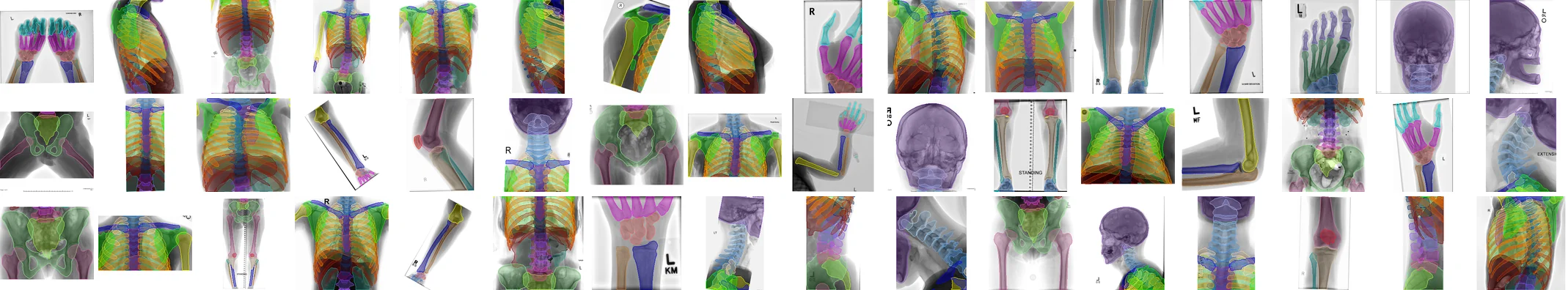 Mosaic of full-body radiographs with FleXray anatomy segmentation overlays