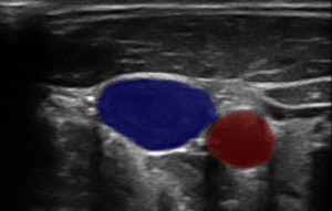 Ultrasound image segmentation using neural netwoks.