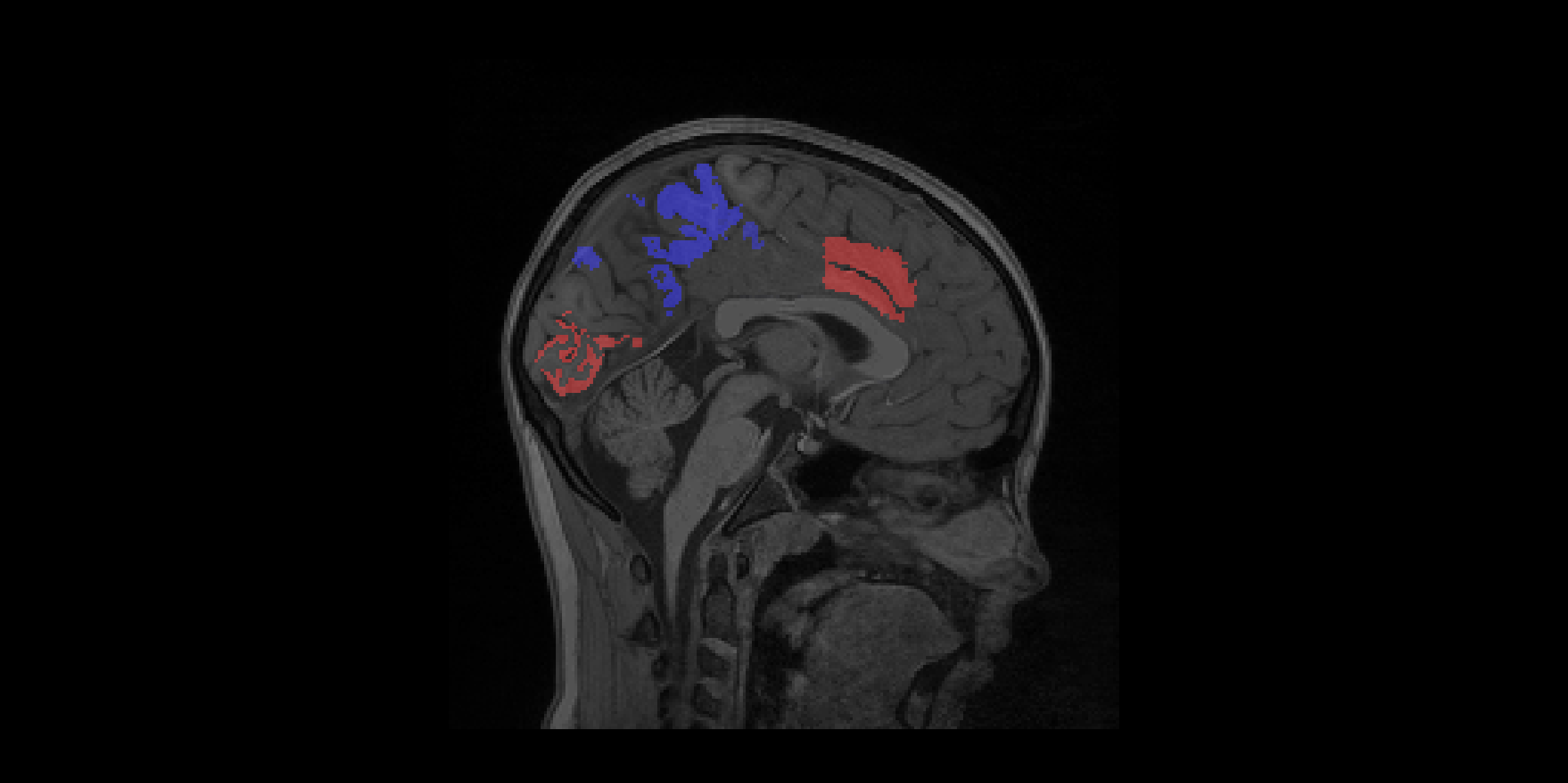 https://github.com/FNNDSC/pl-z2labelmap/wiki/images/subj1-heatmap/frame126.png