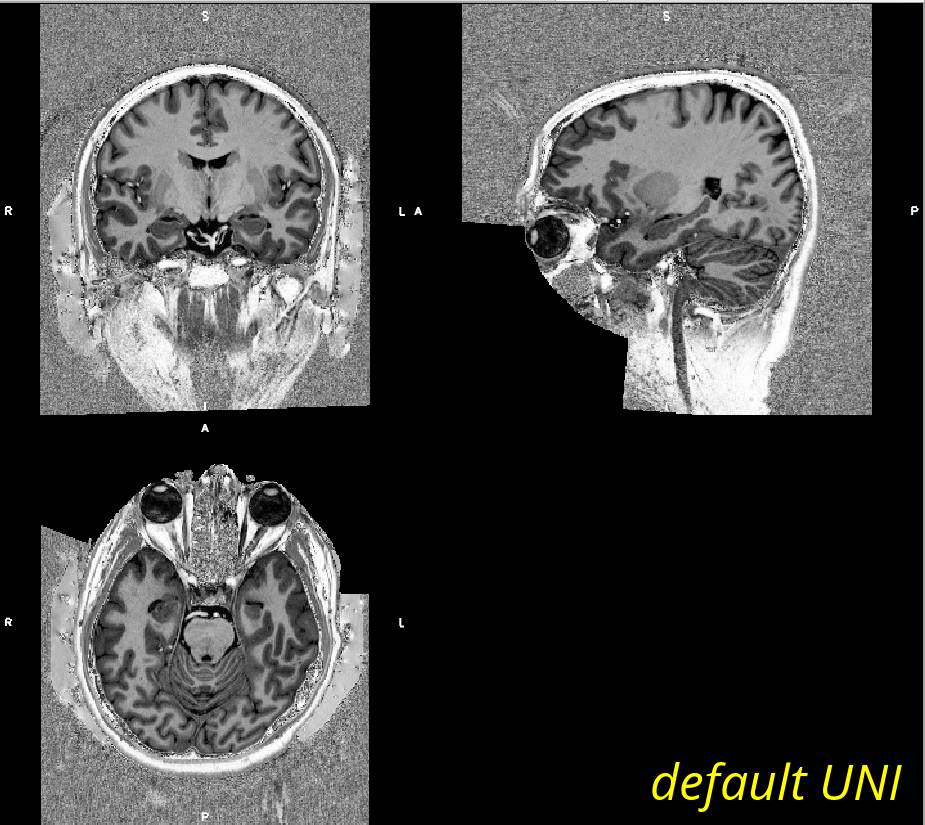 MPRAGEising the UNI image