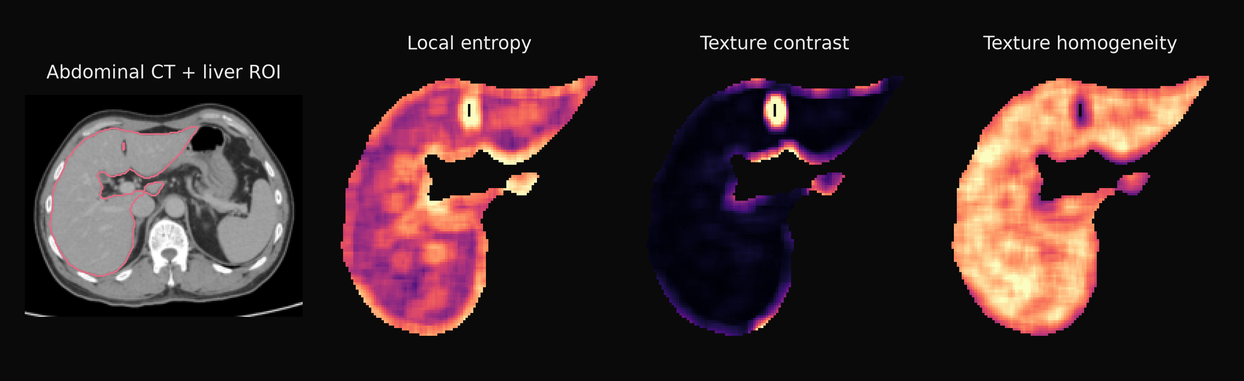 Prewindowed CT liver ROI → local entropy, contrast and homogeneity maps.