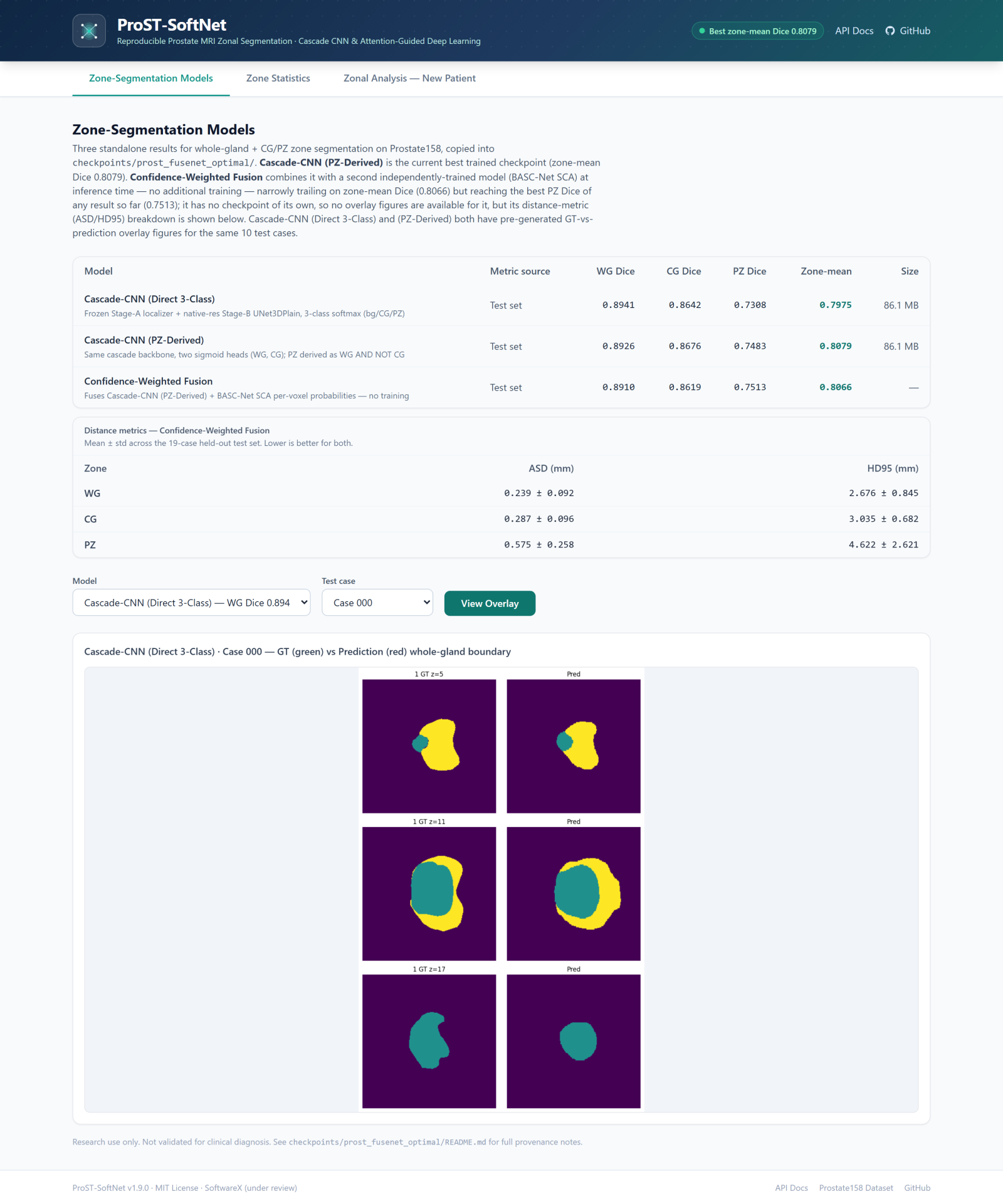 Zone-Segmentation Models tab: metrics comparison table, distance metrics, and a ground-truth vs prediction overlay for one test case