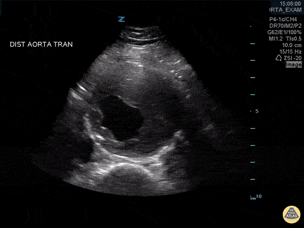 aorta-0