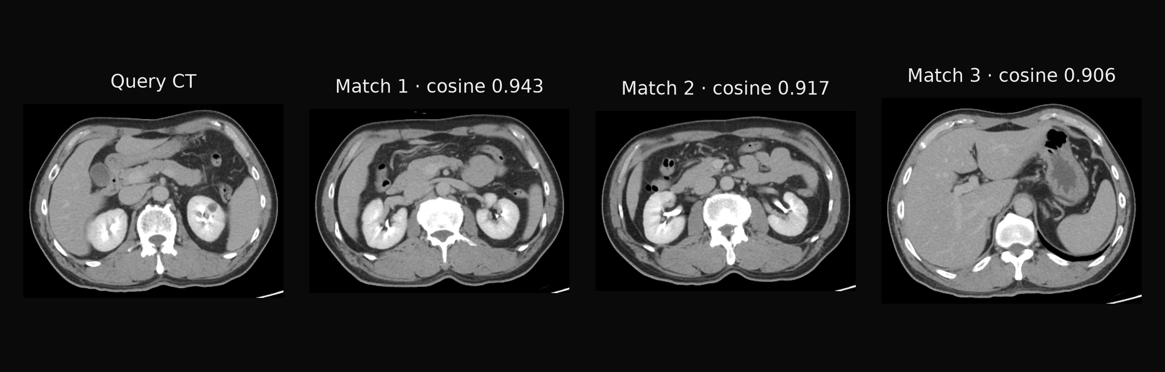 CT → embedding-based image retrieval, ranked by cosine similarity.