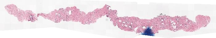 Prostate biopsy sample