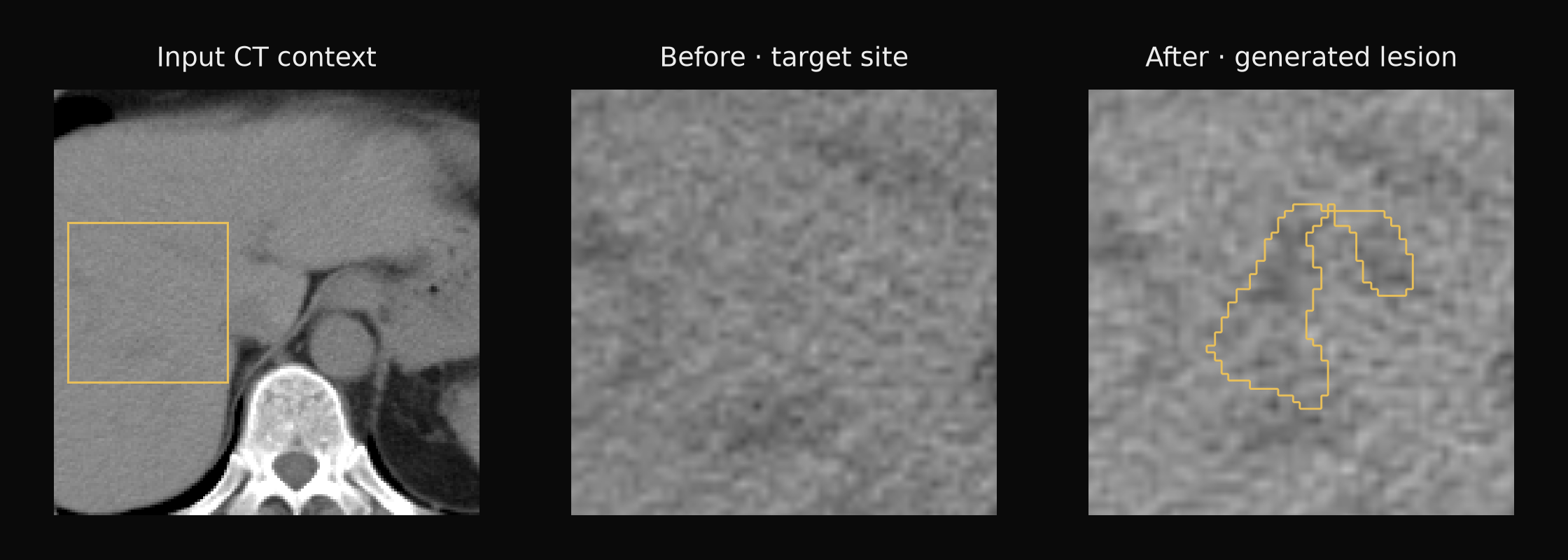 Liver CT before and after lesion generation; the contour marks the generated lesion.