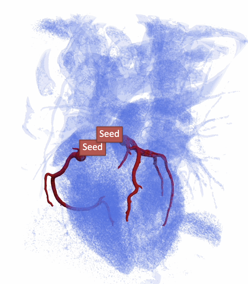 Example coronary segmentation (SeqSeg)