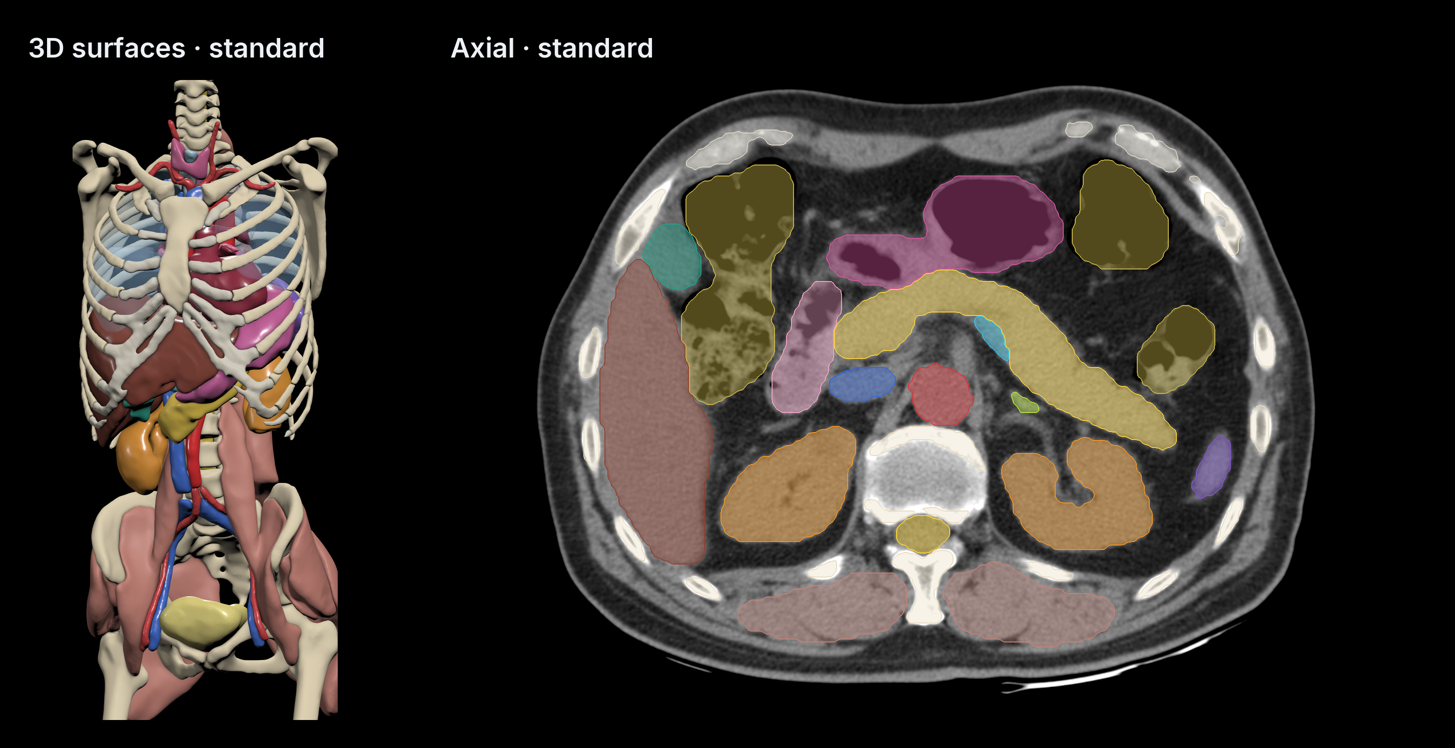 Standard-mode 3D surfaces and axial CT segmentation