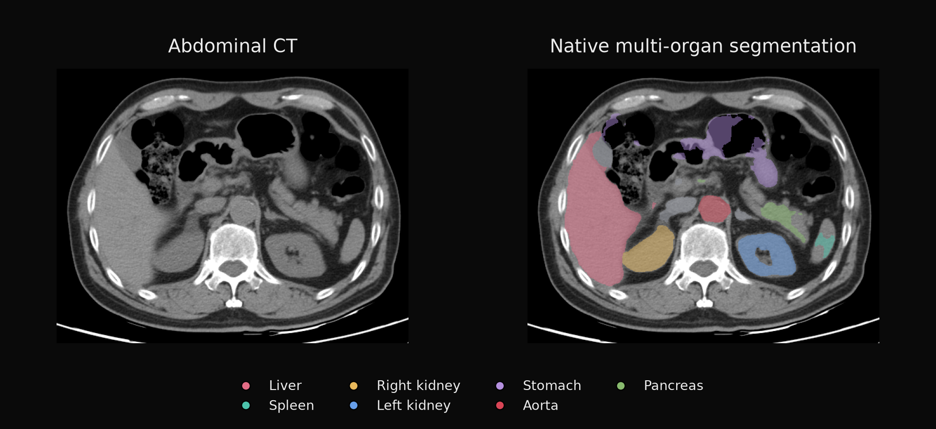 Abdominal CT → multi-organ segmentation.