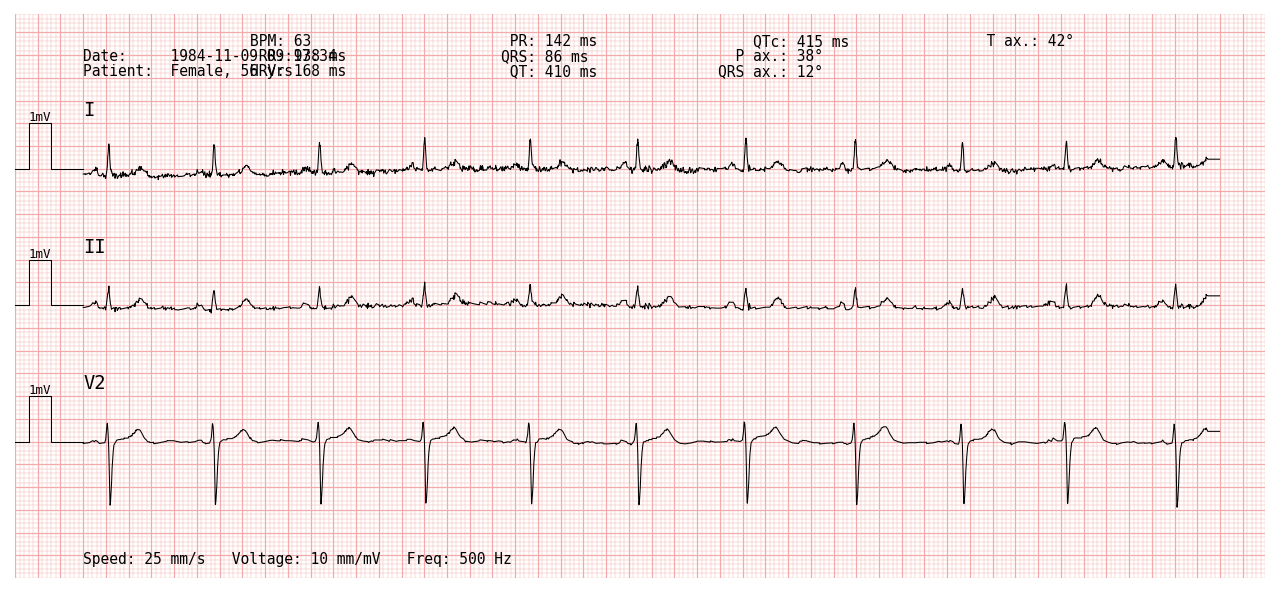 1x3 ECG