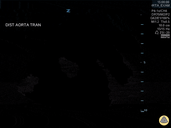 pocus_atlas-aorta-1-background