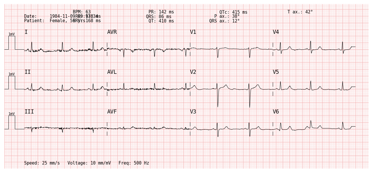 4x3 ECG
